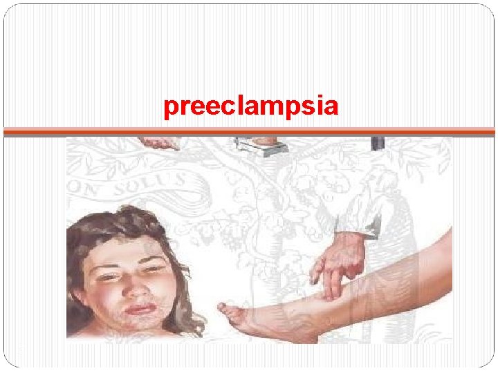 preeclampsia 5 
