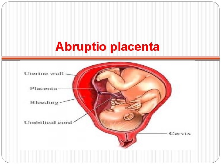 Abruptio placenta 7 
