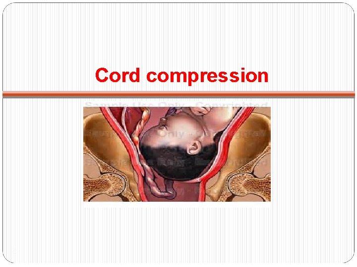 Cord compression 8 