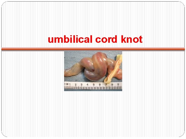 umbilical cord knot 9 