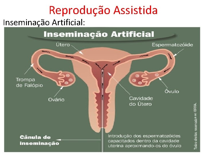 Reprodução Assistida Inseminação Artificial: 