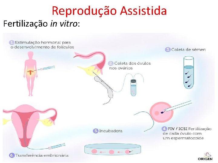 Reprodução Assistida Fertilização in vitro: 