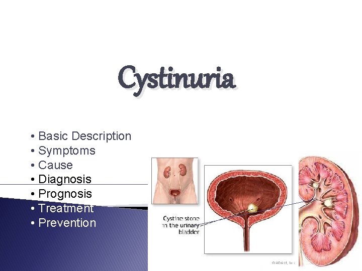 Cystinuria • Basic Description • Symptoms • Cause • Diagnosis • Prognosis • Treatment