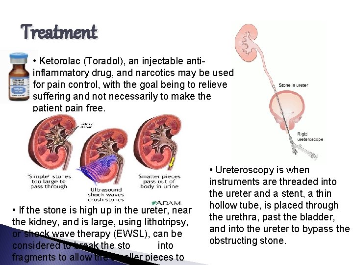 Treatment • Ketorolac (Toradol), an injectable antiinflammatory drug, and narcotics may be used for