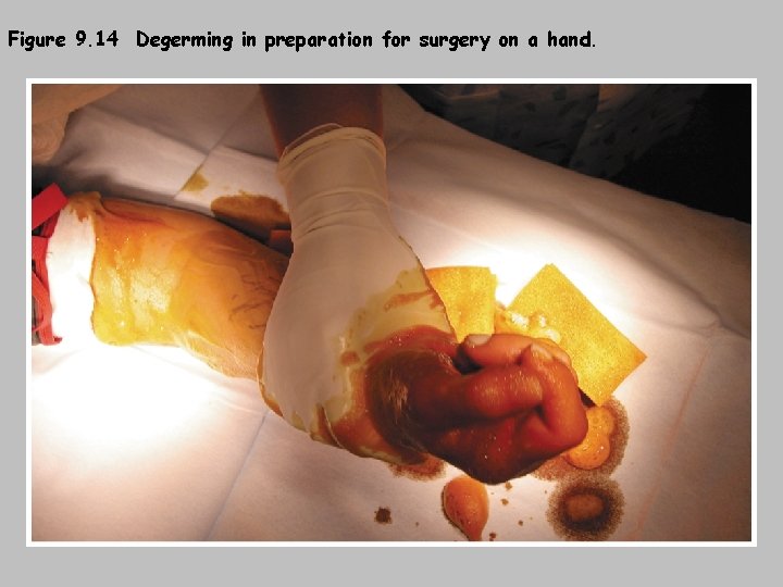 Figure 9. 14 Degerming in preparation for surgery on a hand. 