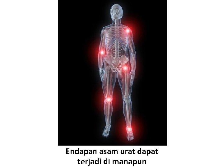 Endapan asam urat dapat terjadi di manapun 