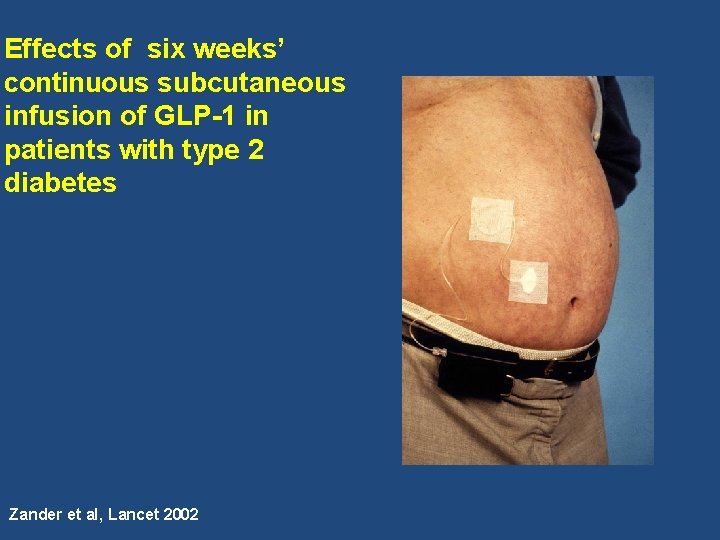 Effects of six weeks’ continuous subcutaneous infusion of GLP-1 in patients with type 2