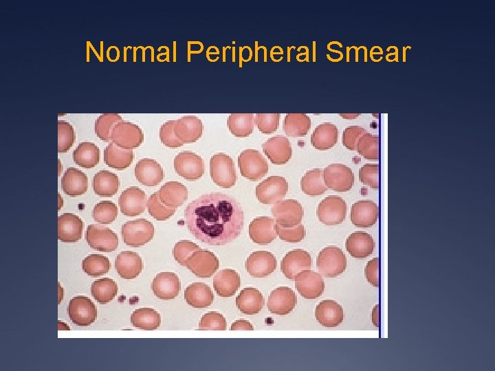 Normal Peripheral Smear 