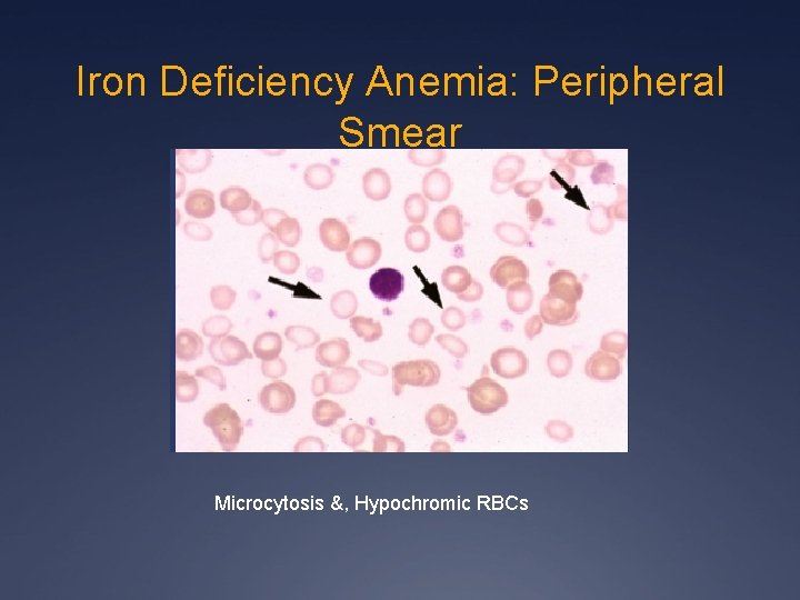 Iron Deficiency Anemia: Peripheral Smear Microcytosis &, Hypochromic RBCs 
