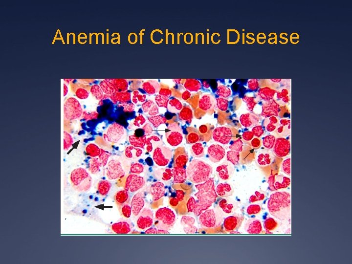Anemia of Chronic Disease 