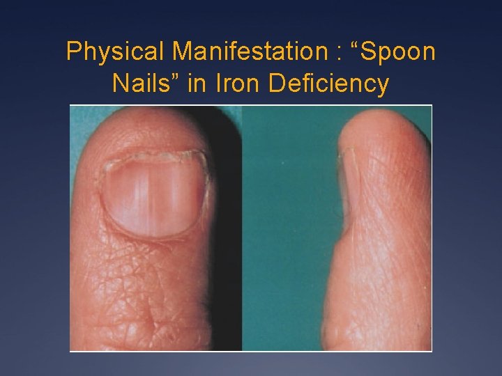 Physical Manifestation : “Spoon Nails” in Iron Deficiency 