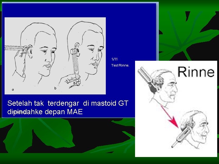 Setelah tak terdengar di mastoid GT dipindahke depan MAE 