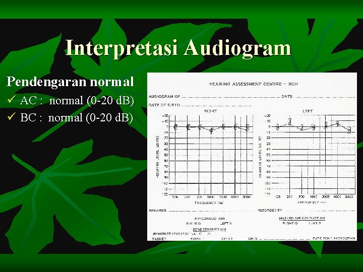 Interpretasi Audiogram Pendengaran normal ü AC : normal (0 -20 d. B) ü BC