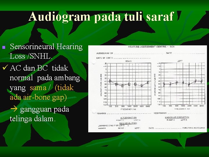 Audiogram pada tuli saraf Sensorineural Hearing Loss /SNHL. ü AC dan BC tidak normal