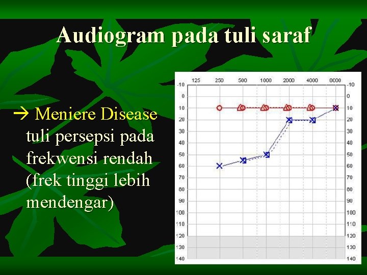 Audiogram pada tuli saraf Meniere Disease tuli persepsi pada frekwensi rendah (frek tinggi lebih