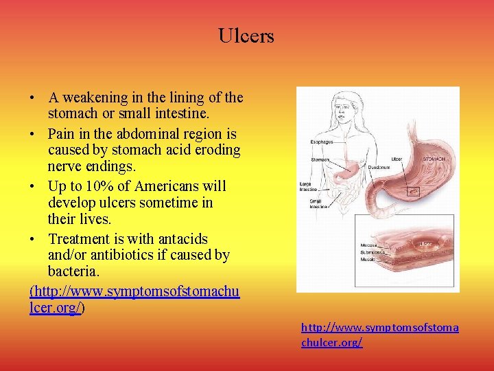 Ulcers • A weakening in the lining of the stomach or small intestine. •
