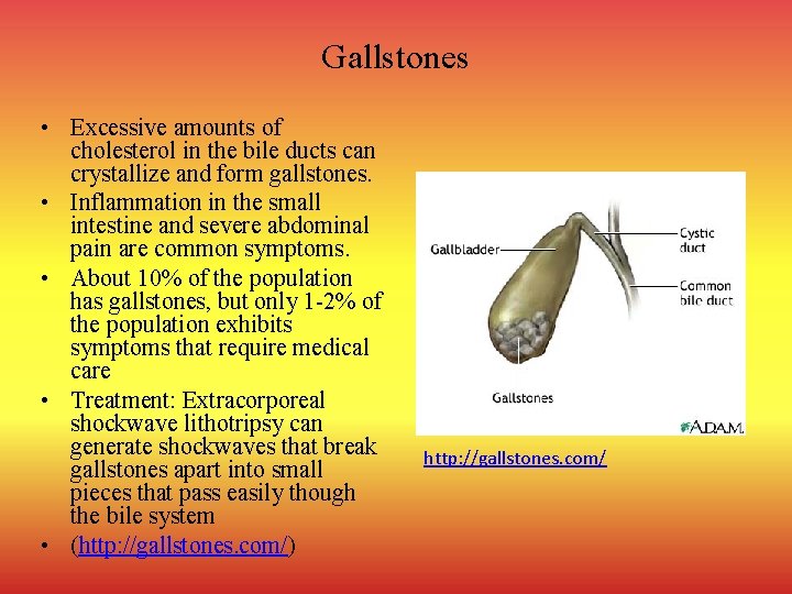 Gallstones • Excessive amounts of cholesterol in the bile ducts can crystallize and form