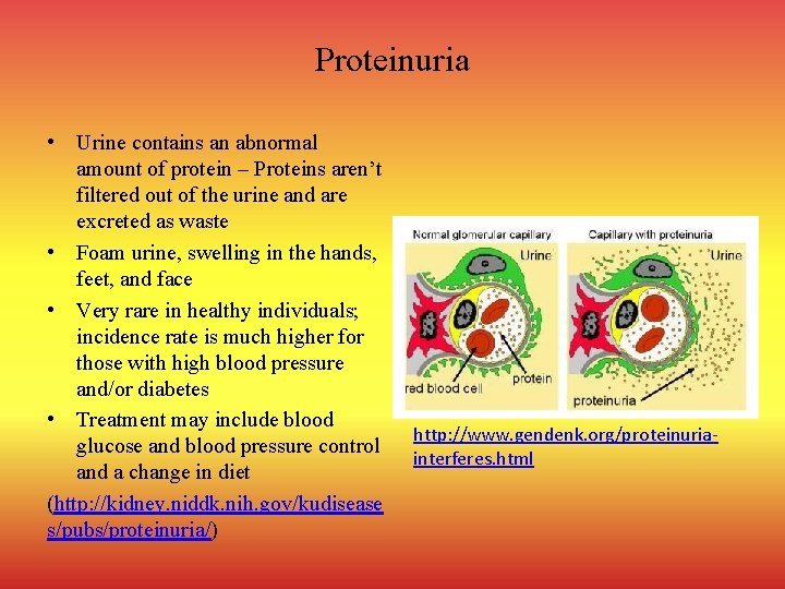 Proteinuria • Urine contains an abnormal amount of protein – Proteins aren’t filtered out
