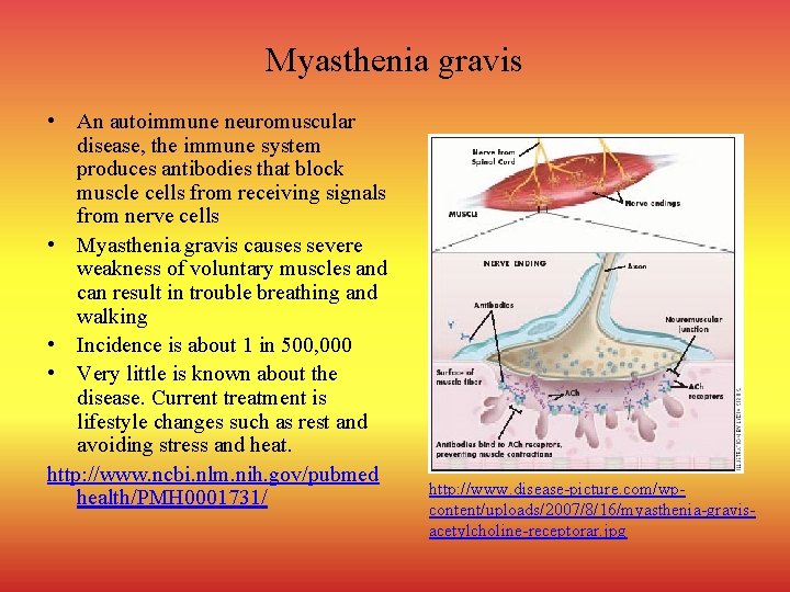Myasthenia gravis • An autoimmune neuromuscular disease, the immune system produces antibodies that block