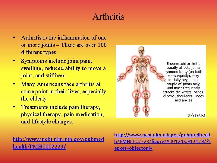 Arthritis • Arthritis is the inflammation of one or more joints – There are
