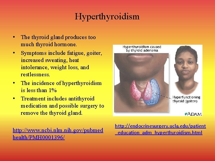 Hyperthyroidism • The thyroid gland produces too much thyroid hormone. • Symptoms include fatigue,