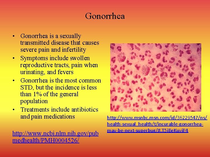 Gonorrhea • Gonorrhea is a sexually transmitted disease that causes severe pain and infertility