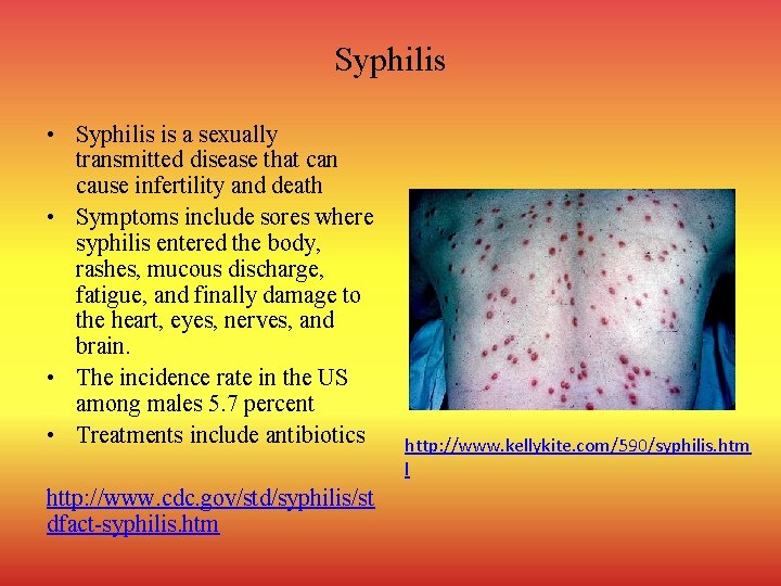 Syphilis • Syphilis is a sexually transmitted disease that can cause infertility and death