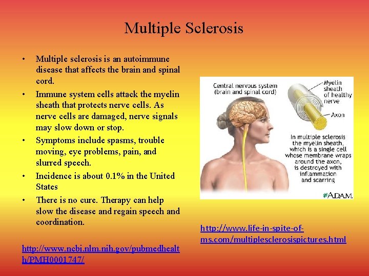 Multiple Sclerosis • • • Multiple sclerosis is an autoimmune disease that affects the