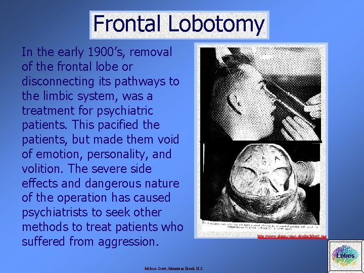 Frontal Lobotomy In the early 1900’s, removal of the frontal lobe or disconnecting its