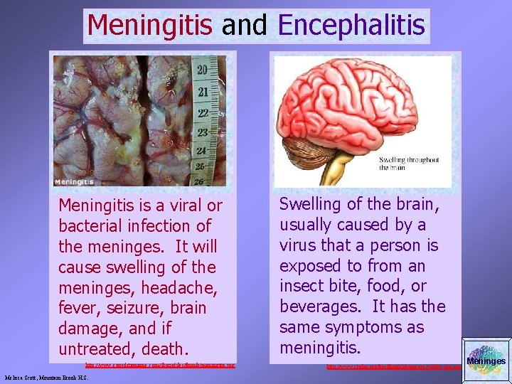 Meningitis and Encephalitis Meningitis is a viral or bacterial infection of the meninges. It
