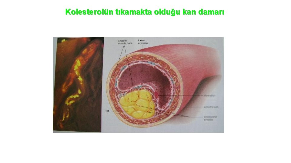 Kolesterolün tıkamakta olduğu kan damarı 