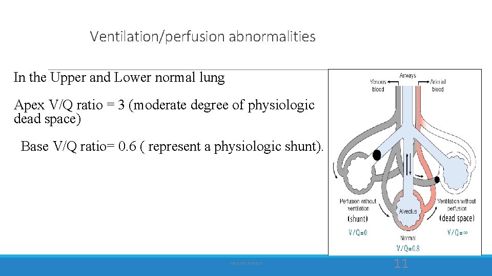 Ventilation/perfusion abnormalities In the Upper and Lower normal lung Apex V/Q ratio = 3