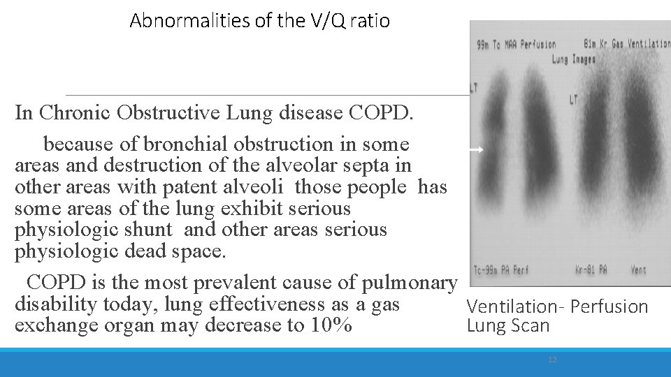 Abnormalities of the V/Q ratio In Chronic Obstructive Lung disease COPD. because of bronchial
