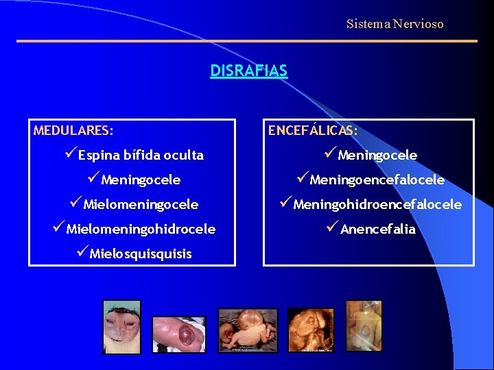 Sistema Nervioso DISRAFIAS MEDULARES: üEspina bífida oculta üMeningocele üMielomeningohidrocele üMielosquisis ENCEFÁLICAS: üMeningocele üMeningoencefalocele üMeningohidroencefalocele