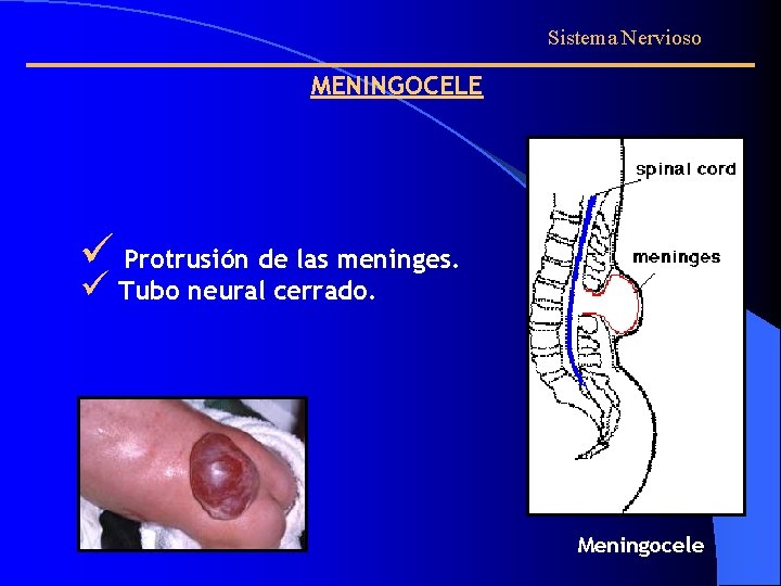 Sistema Nervioso MENINGOCELE ü Protrusión de las meninges. ü Tubo neural cerrado. Meningocele 