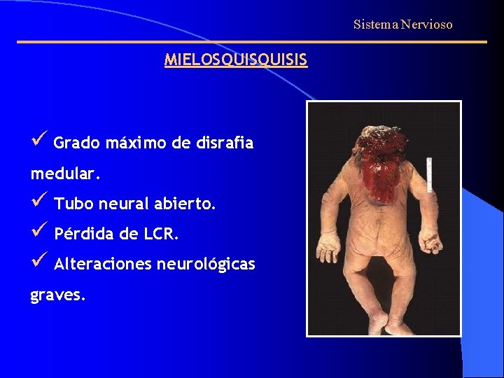 Sistema Nervioso MIELOSQUISIS ü Grado máximo de disrafia medular. ü Tubo neural abierto. ü