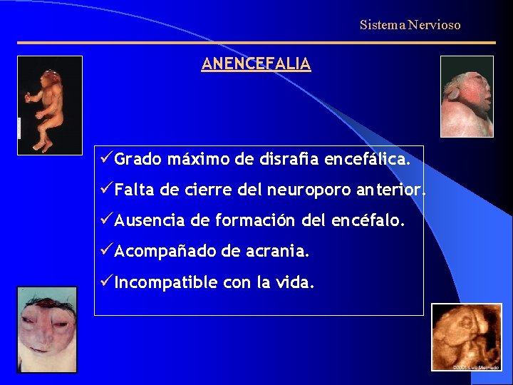 Sistema Nervioso ANENCEFALIA üGrado máximo de disrafia encefálica. üFalta de cierre del neuroporo anterior.