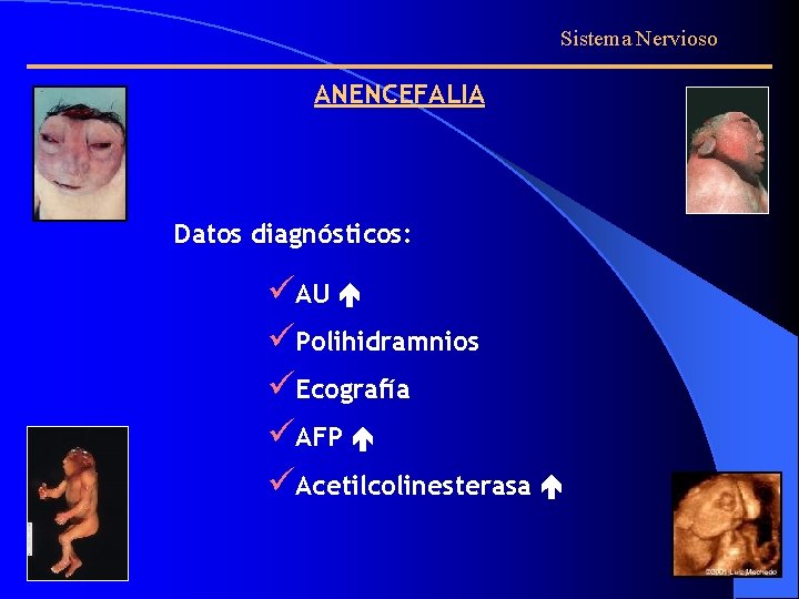 Sistema Nervioso ANENCEFALIA Datos diagnósticos: üAU üPolihidramnios üEcografía üAFP üAcetilcolinesterasa 