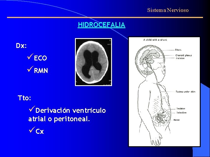 Sistema Nervioso HIDROCEFALIA Dx: üECO üRMN Tto: üDerivación ventrículo atrial o peritoneal. üCx 