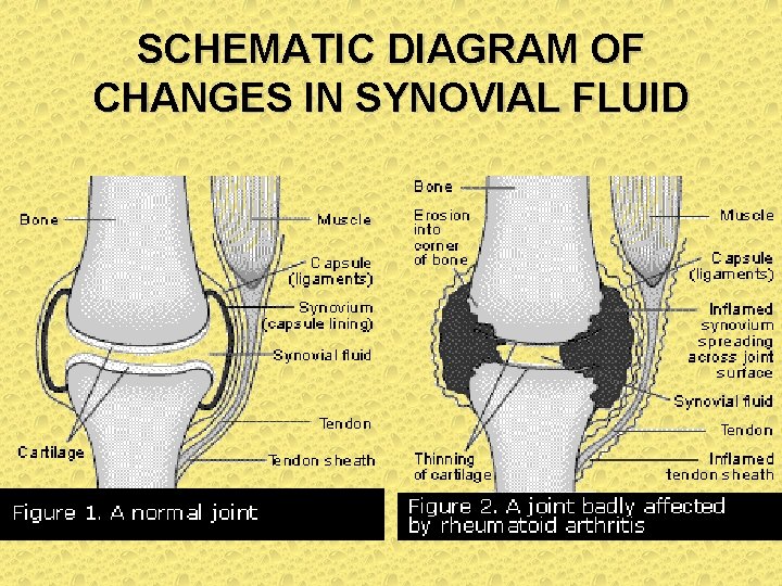 SCHEMATIC DIAGRAM OF CHANGES IN SYNOVIAL FLUID SCHEMATIC DIAGRAM OF CHANGES IN SYNOVIAL FLUID