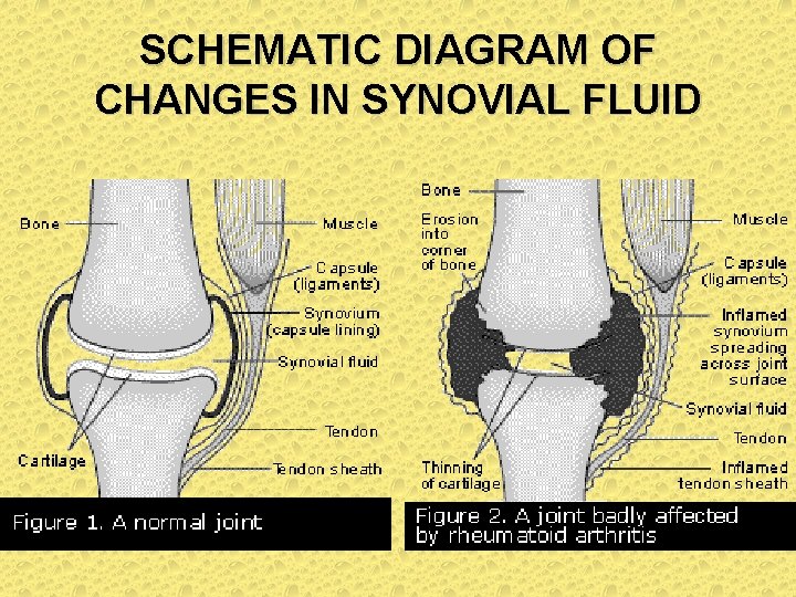 SCHEMATIC DIAGRAM OF CHANGES IN SYNOVIAL FLUID 