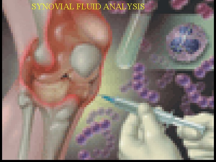 SYNOVIAL FLUID ANALYSIS SYNOVIAL FLUID ANALYSIS