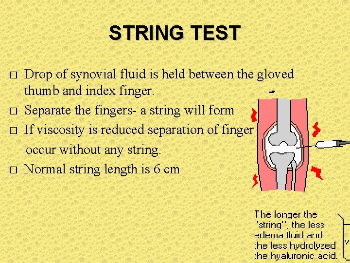 STRING TEST Drop of synovial fluid is held between the gloved thumb and index STRING TEST Drop of synovial fluid is held between the gloved thumb and index