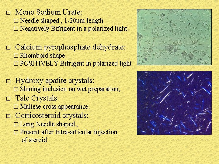 � Mono Sodium Urate: � Needle shaped , 1 -20 um length � Negatively � Mono Sodium Urate: � Needle shaped , 1 -20 um length � Negatively