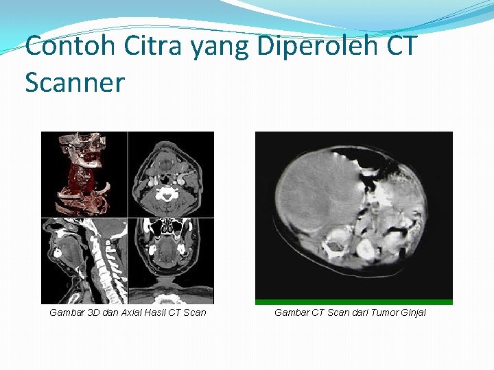 Contoh Citra yang Diperoleh CT Scanner Gambar 3 D dan Axial Hasil CT Scan