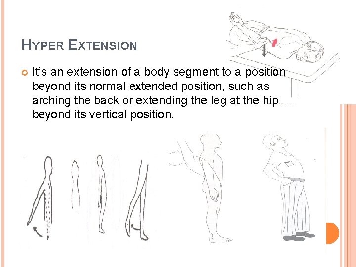 HYPER EXTENSION It’s an extension of a body segment to a position beyond its