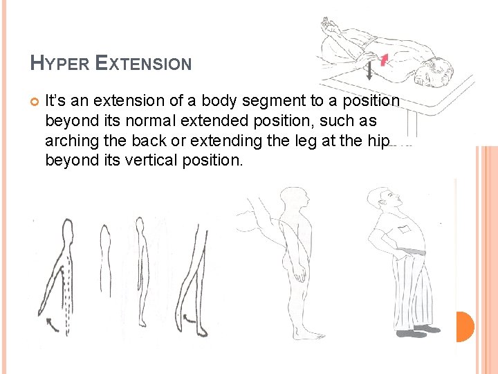 HYPER EXTENSION It’s an extension of a body segment to a position beyond its HYPER EXTENSION It’s an extension of a body segment to a position beyond its