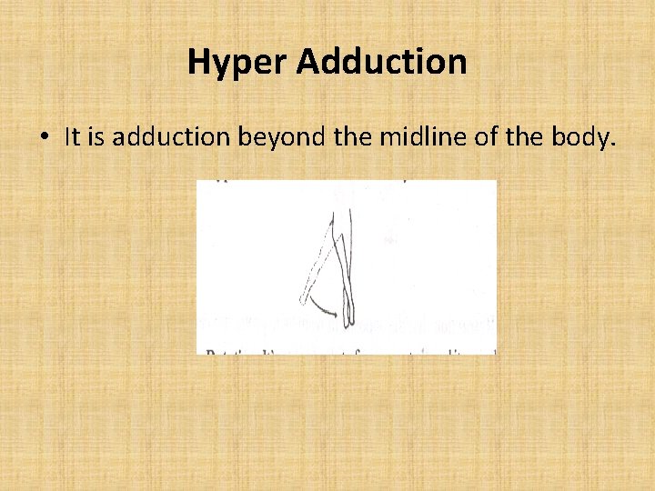 Hyper Adduction • It is adduction beyond the midline of the body. Hyper Adduction • It is adduction beyond the midline of the body.