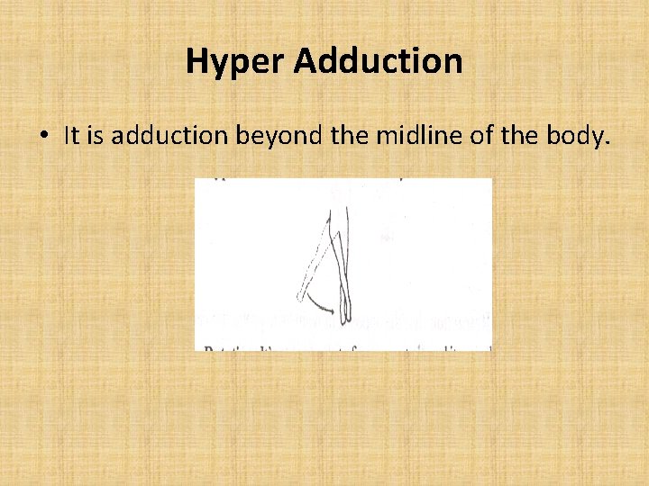 Hyper Adduction • It is adduction beyond the midline of the body. 