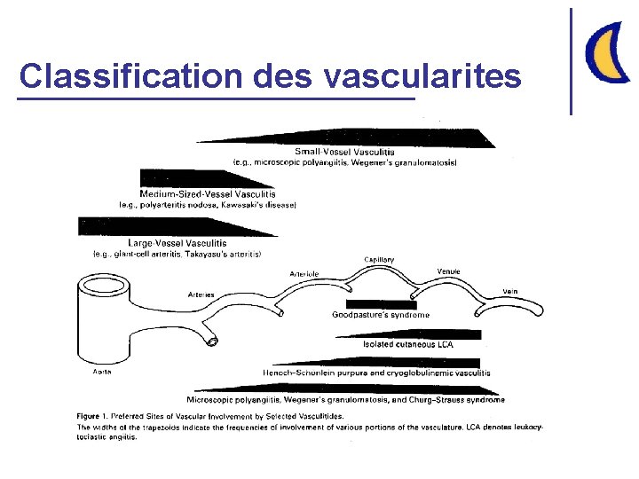 Classification des vascularites 